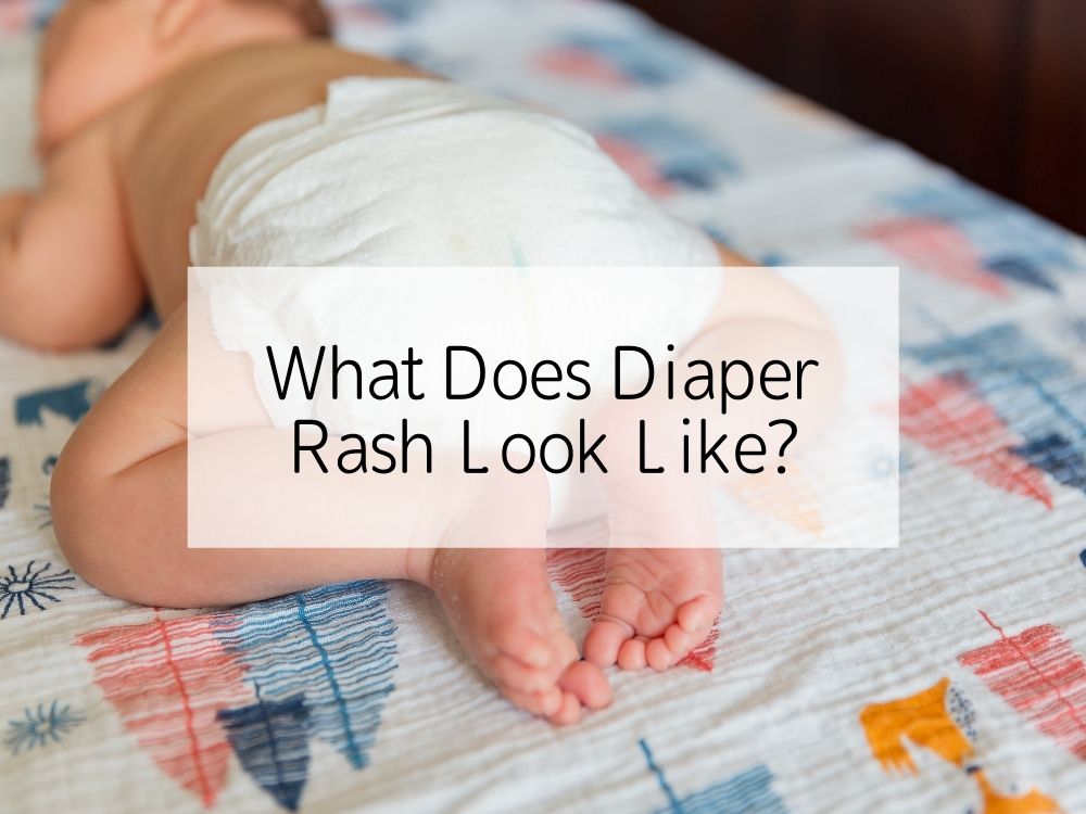 What Does Diaper Rash Look Like?